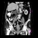 Hydronephrosis, ureterolithiasis: CT - Computed tomography